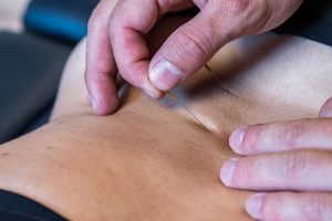 Akupunkturbehandling hos Efficax som del af osteopati og fysioterapi for ondt i mave.